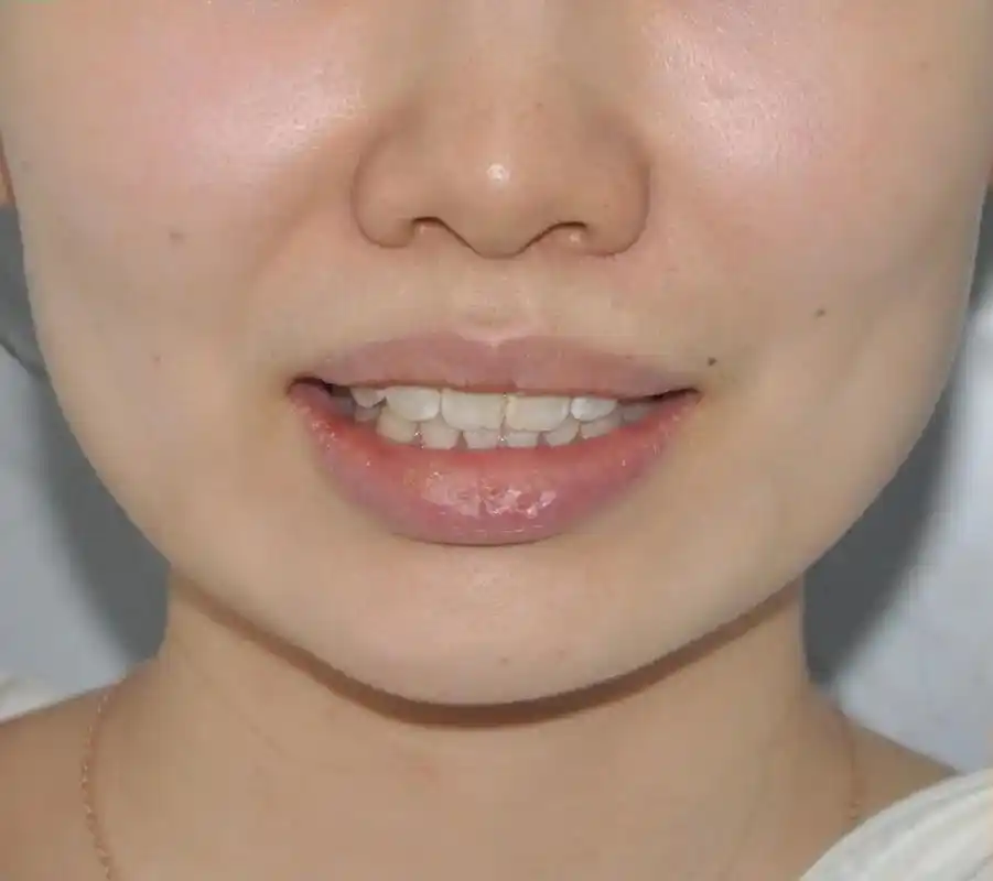 meimei案例分享丨肉毒素调嘴歪法令纹.很多人嘴歪却不自知 - 抖音