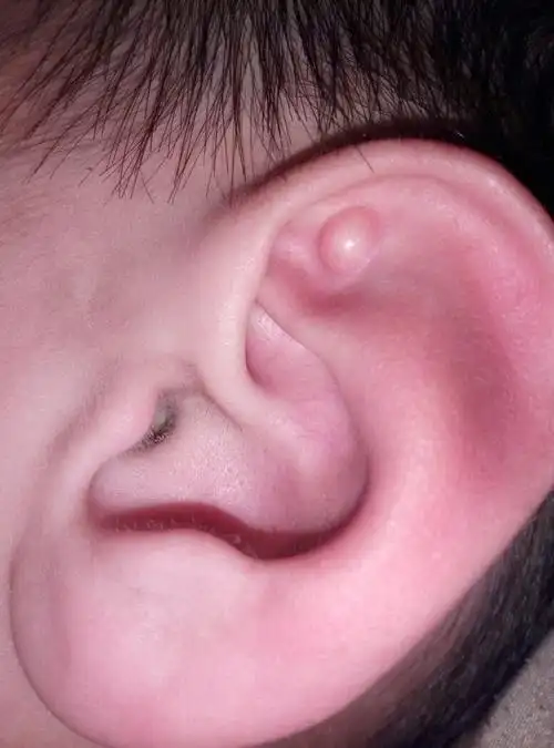 6岁孩子耳廓三角窝处长了一个包,怎么治?