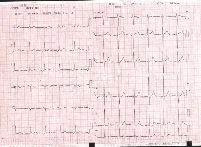 冠状窦心律? - 心电图脑电图专业讨论版 - 爱爱医医学论坛