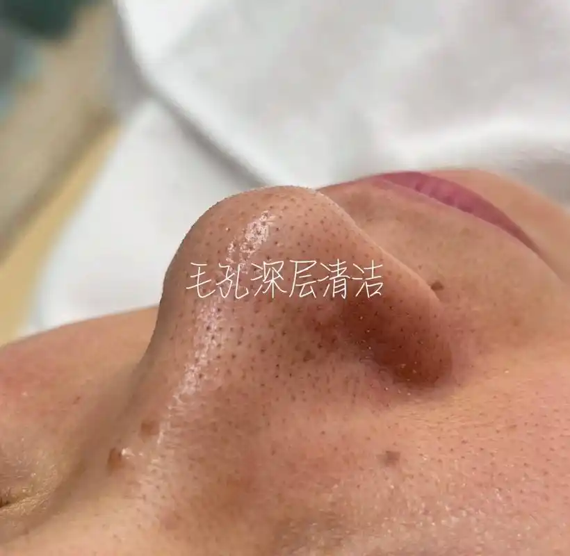 毛孔深层清洁护理