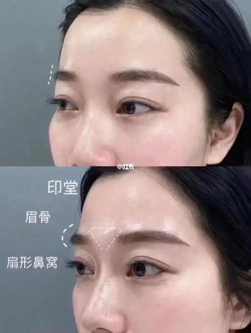 少女针眉弓改善的不是一点点