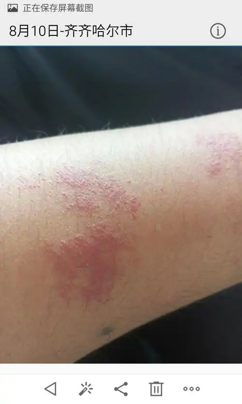 胳膊前臂出现红斑,好多年了,不痛不痒,最开始只有一片,慢慢旁边也出现