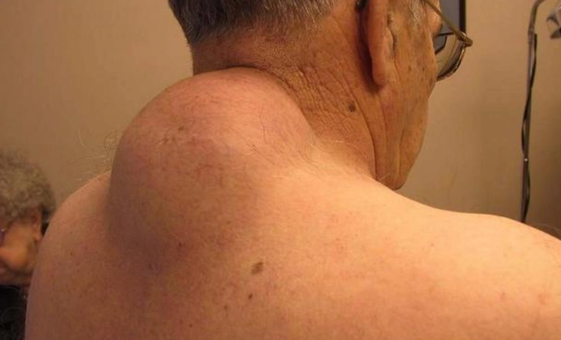 为什么人体会长出脂肪瘤这种东西?这一项是"罪魁祸首"!