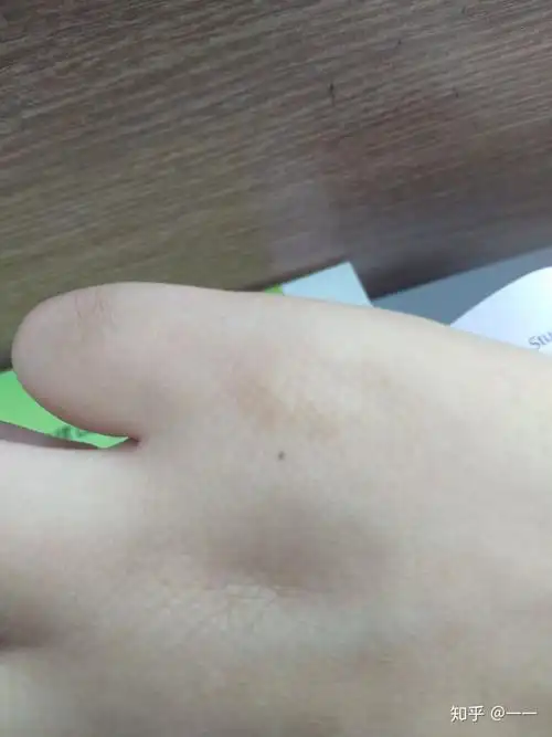 手指突然间长出一个痣会不会变成黑色素瘤实验室经常接触些生化物品