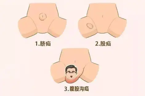 健康随行丨勿以"疝"小而不为|疝气|健康随行_新浪新闻