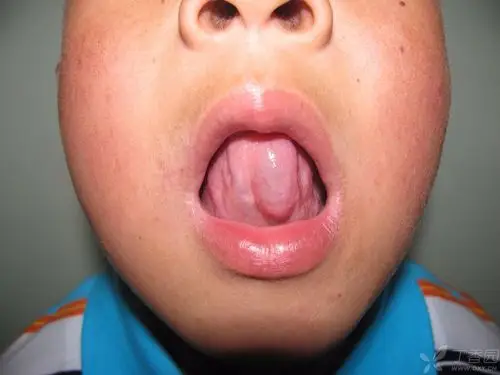 >> 不再显示 ×相对小唾液腺来讲舌前腺体积大,位置深,对舌前腺囊肿