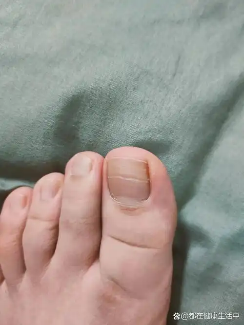 脚趾甲上有一条凹凸的横纹