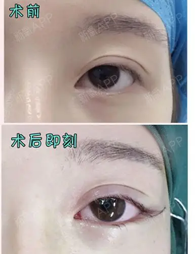 改变眼型的神奇开眼角术