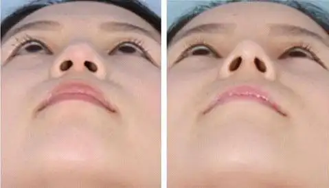 鼻小柱延长手术效果好吗?