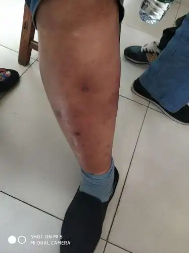 下肢脉管炎,九月二十九日就诊,下肢红肿,肤色紫暗,皮温高,局部疼痛