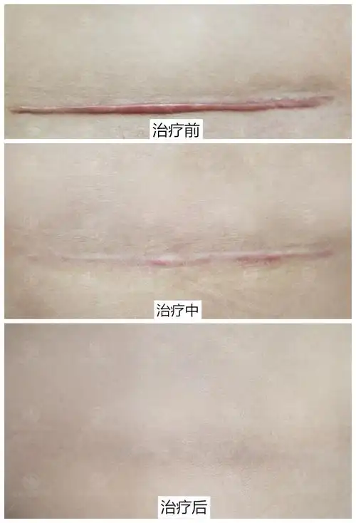 肚子剖腹产疤痕2年了很难看可以祛除吗