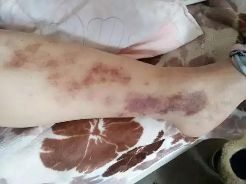 我母亲56岁,脚踝小腿部红色斑块或小点,医生诊断紫癜样皮炎,吃几个月