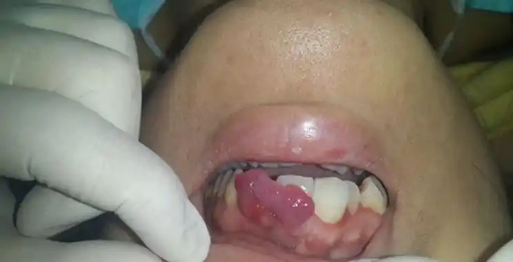 牙癌的症状和外部图片9牙龈癌的初期3个症状非常明显但很多人都忽视了