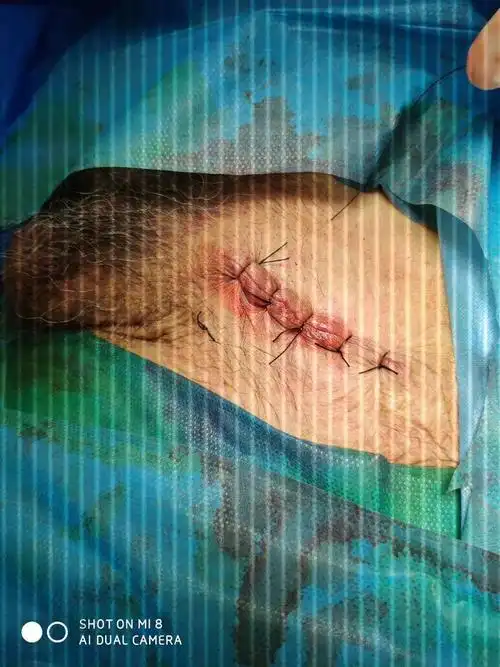 腹股沟疝发展史