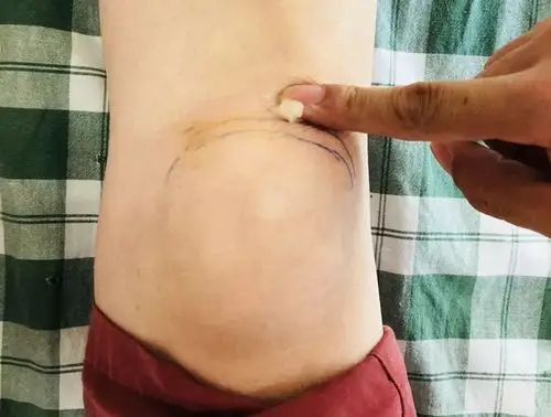 她的膝关节疼痛主要是由于髌下脂肪垫受寒造成的,并给王女士制定了一