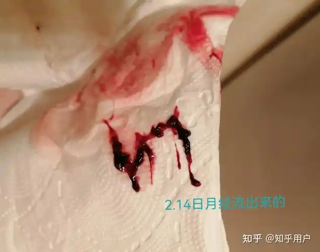 药流后有35cm残留保守治疗近80天清楚残留