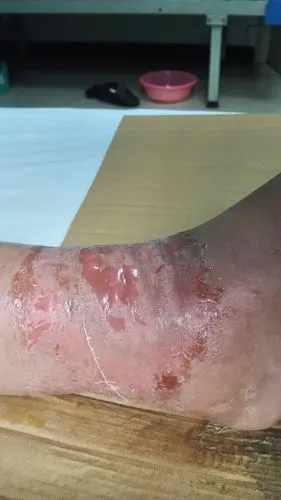 右踝关节皮肤红,肿,痛伴分泌物3天