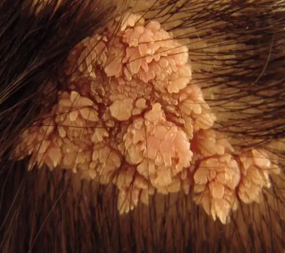 出生后头皮上就有一块斑一样的东西,现在越长越大,究竟是什么呢?