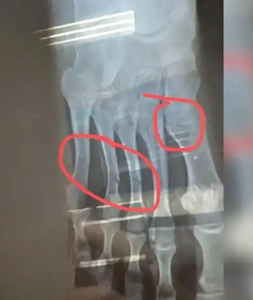 健身房女会员4根脚趾被砸断现场令人无语请远离无脑健身