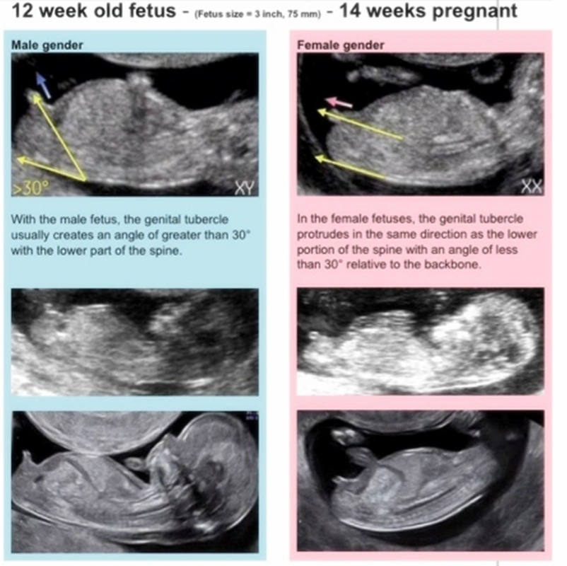 风险!胎儿性别预测"熙熙攘攘"-第1张图片-南瑞博客