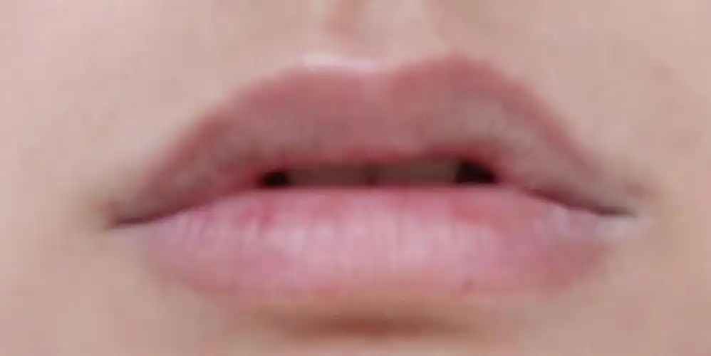 问下大家,我这嘴唇有一层白的是唇炎吗?怎么解决