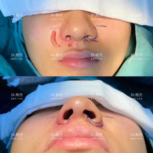 内外联合鼻翼缩小