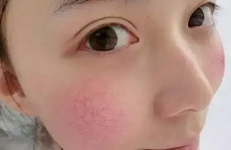 三步告别冬季敏感肌肤海洋物语