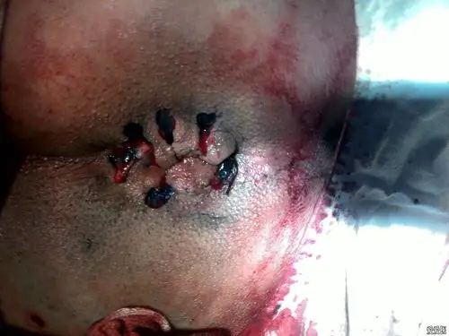 后左侧卧位   病史简介:患者男,57岁,间歇性便血伴肛门肿物脱出10余年