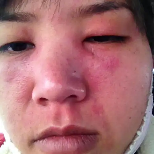 脸被蒸汽烫伤三个月了,看似好了,但是晒到太阳,或者是洗热水澡,吹风机