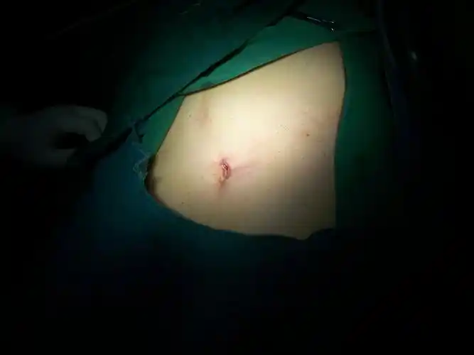 无瘢痕手术就在我们身边——关于单孔腹腔镜手术