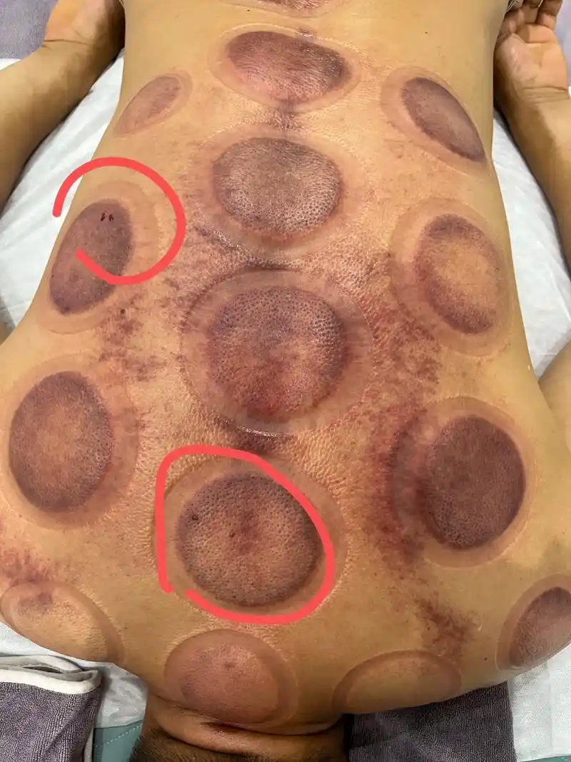 拔罐出水泡,水泡背后隐藏了你身体亚健康的真相 # - 抖音