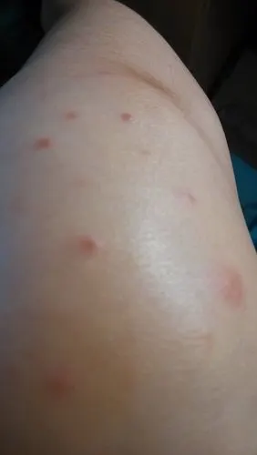 问:您好,我的腿上,胳膊上起了这样连片的红色疙瘩,有点痒,最近起了