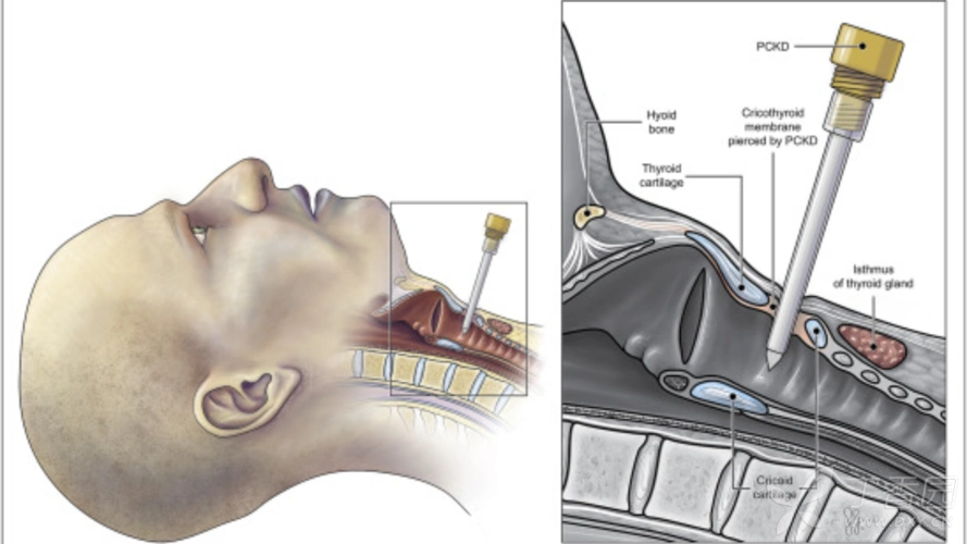 环甲膜穿刺/切开术及相关解剖美图 - 丁香园论坛