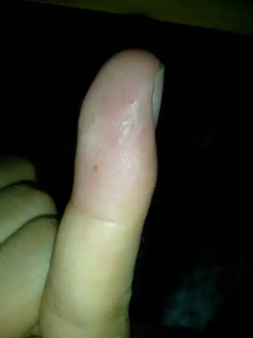 手指不时的起这样的小泡泡,然后我就抠破它.请问这是为什么会起?