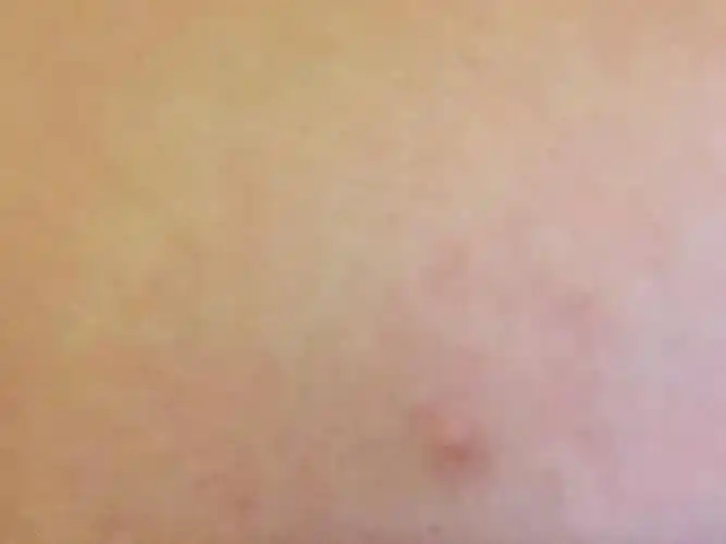 胸口长的这个痘痘摸上去是一粒一粒的人家说是淋巴结