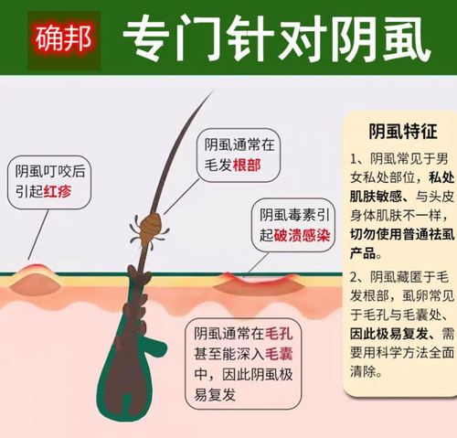 阴虱药百部酊男士用喷剂女私处去虱子药一扫光除虱卵阴虱净灭虱灵