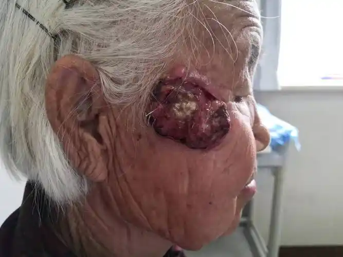 面部皮肤癌_皮肤癌_皮肤癌症状表现 - 好大夫在线