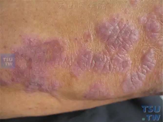 【附图】 扁平苔藓(lichen planus)的症状表现 _皮肤病诊断图谱