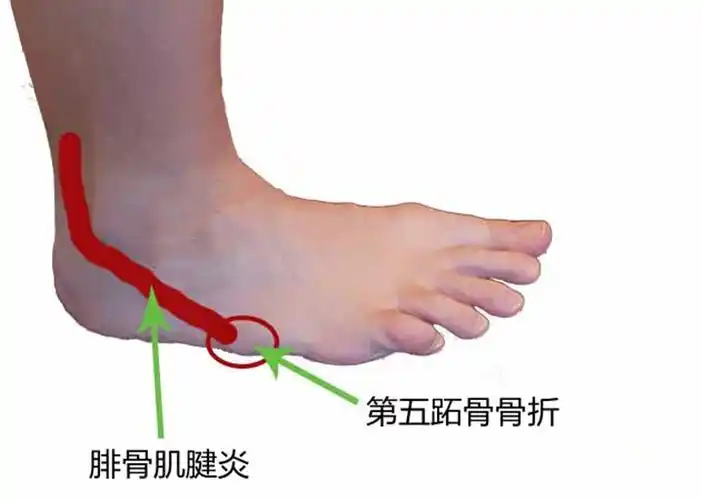 脚侧面疼是怎么回事怎么治(脚的外侧出现疼痛,一般是这几个原因造成的