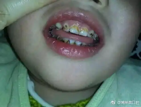 用洁净的纱布包裹自己的手指沾净水帮孩子洗去牙齿及牙床上的附著物