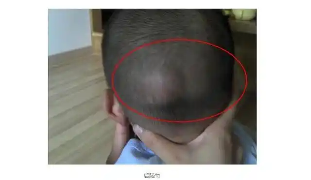 因为这意味着宝宝很聪明|宝宝智商|头骨|枕骨_网易订阅