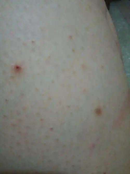 毛孔堵塞怎么办.大腿手臂都有.