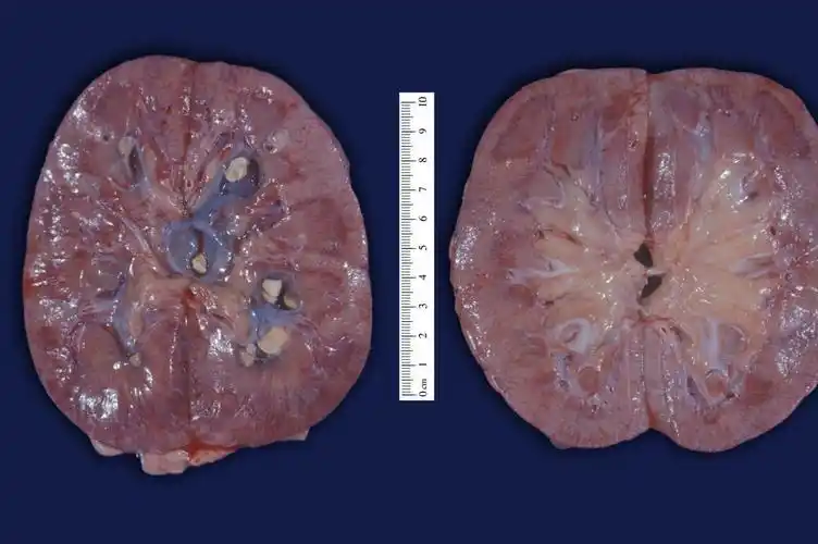 血尿,恶心呕吐等,具体不适症状与结石的大小,形状等有关