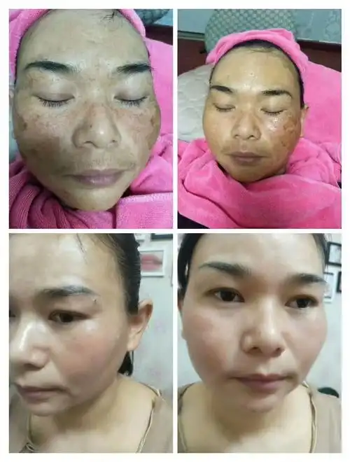 左各庄班豆夫人祛斑祛痘十一大放送