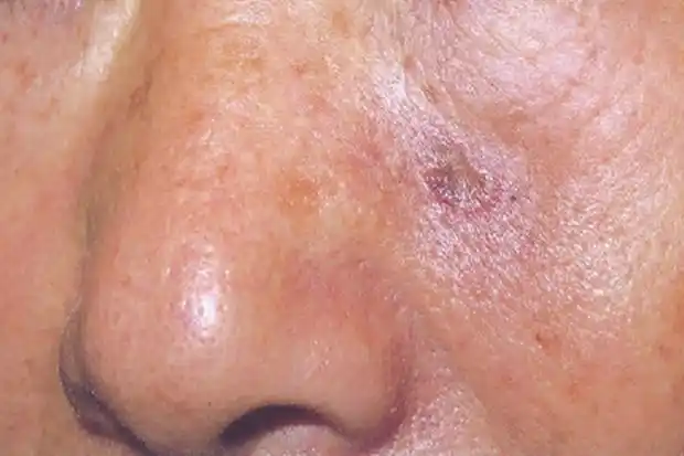 硬斑病样型基底细胞癌图