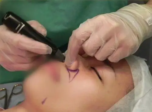 加强颜面美感的鼻基底整形术