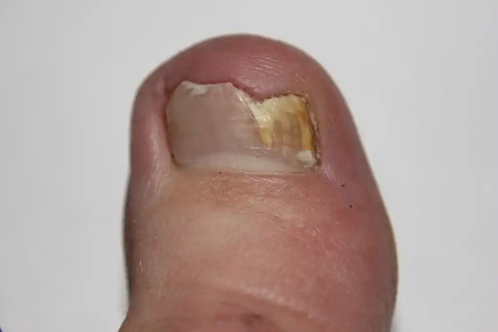 灰指甲,灰指甲传染性疾病