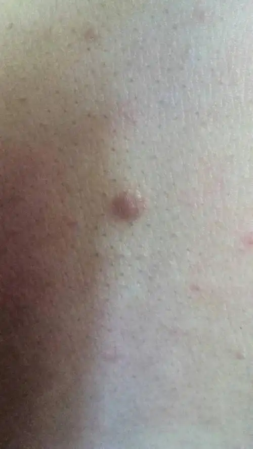 胸口起个疙瘩,有一段时间了吧.