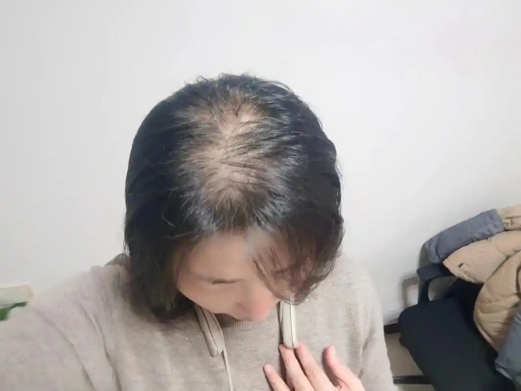 拯救发际线 秃头女孩发现了春天 本来快完蛋了,在生发机构花 - 抖音