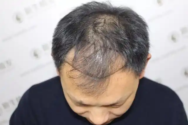 5亿,平均每6人中就有一人脱发,30岁前脱发的比例高达84%,头发大把大把